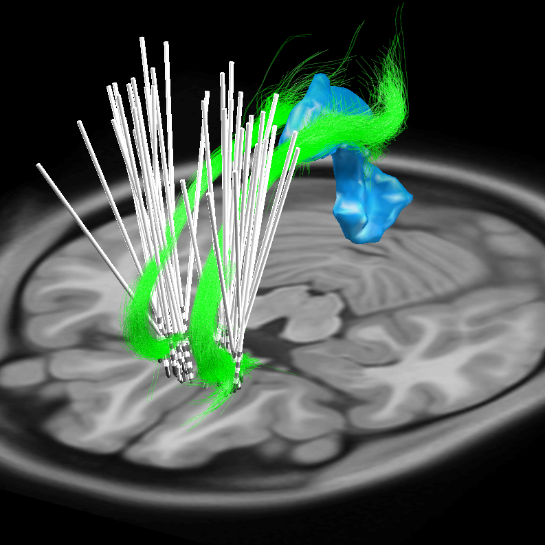 DBS electrodes in subgenual cingulate gyri Digital model of deep brain stimulator (DBS) electrodes bilaterally placed in the subthalamic nuclei of a patient with Parkinson's disease