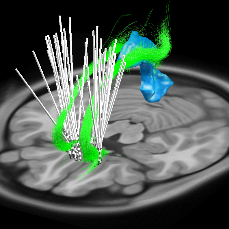 Digital model of deep brain stimulator (DBS) electrodes bilaterally placed in the subthalamic nuclei of a patient with Parkinson's disease