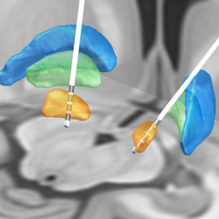 DBS electrodes in subthalamic nuclei Digital model of deep brain stimulator (DPS) electrodes bilaterally placed in the subthalamic nuclei of a patient with Parkinson's disease