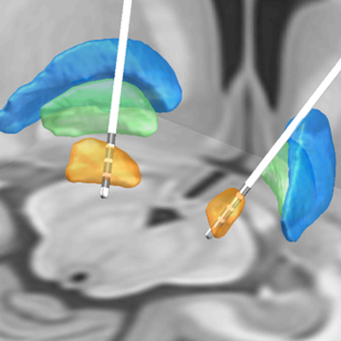 Digital model of deep brain stimulator (DPS) electrodes bilaterally placed in the subthalamic nuclei of a patient with Parkinson's disease