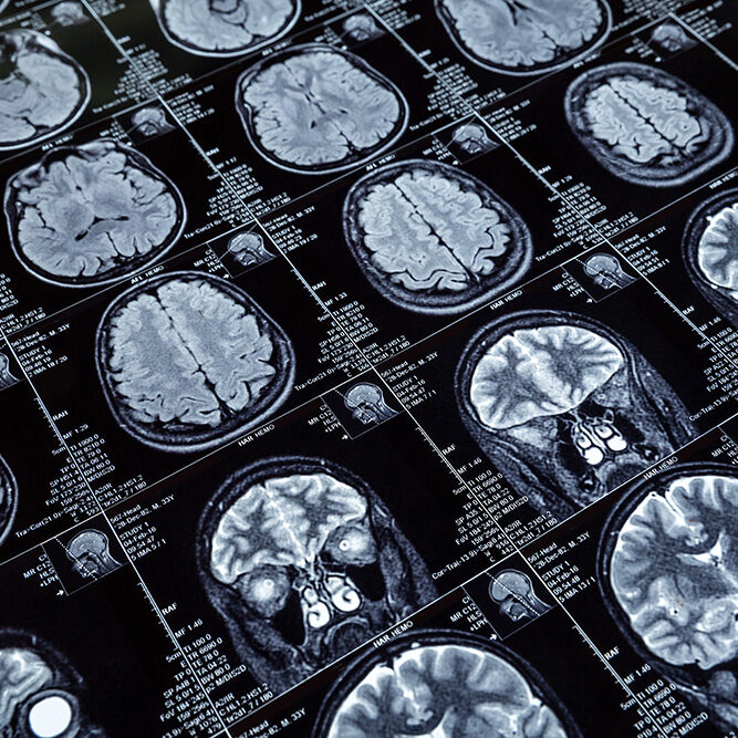 MRI scans Magnetic resonance imaging (MRI) brain scans